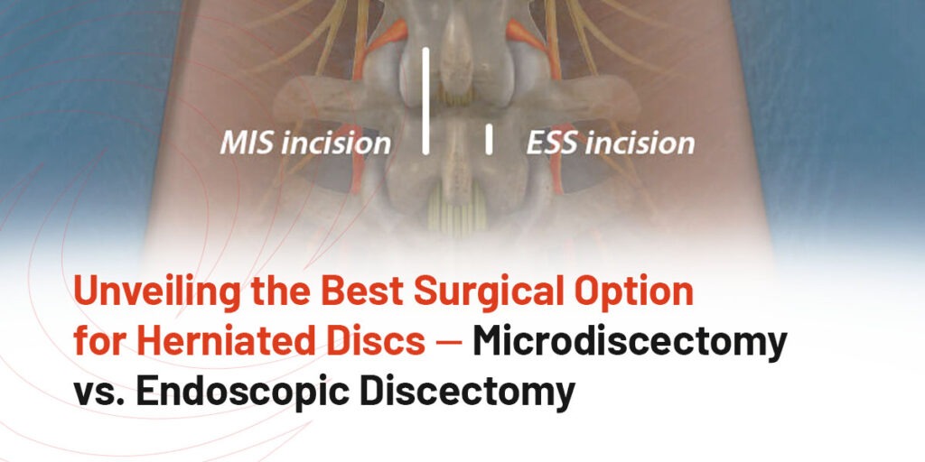 Unveiling the Best Surgical Option for Herniated Discs &mdash; Microdiscectomy vs. Endoscopic Discectomy