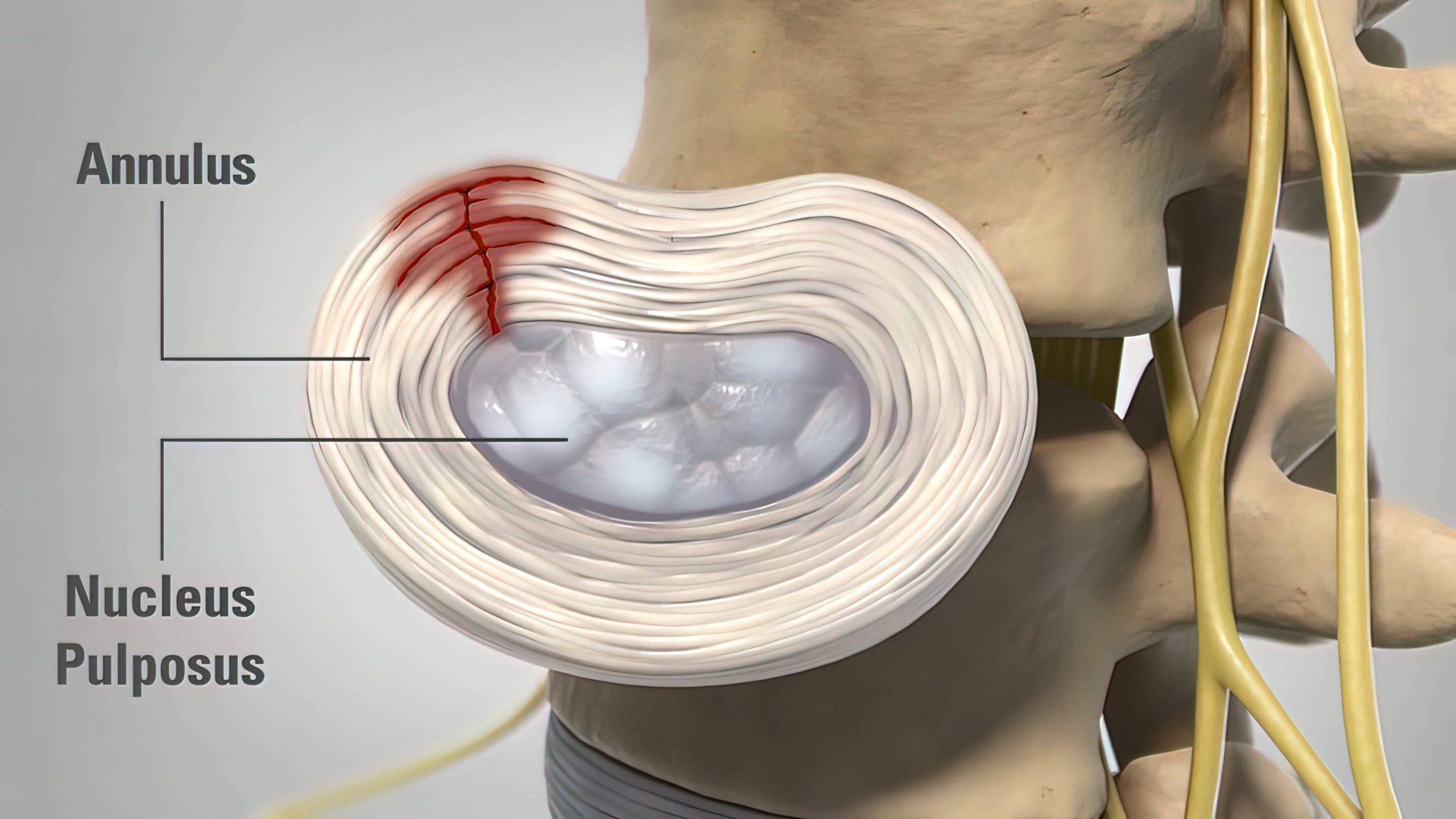 A Diagram Showing An Annular Disc Tear