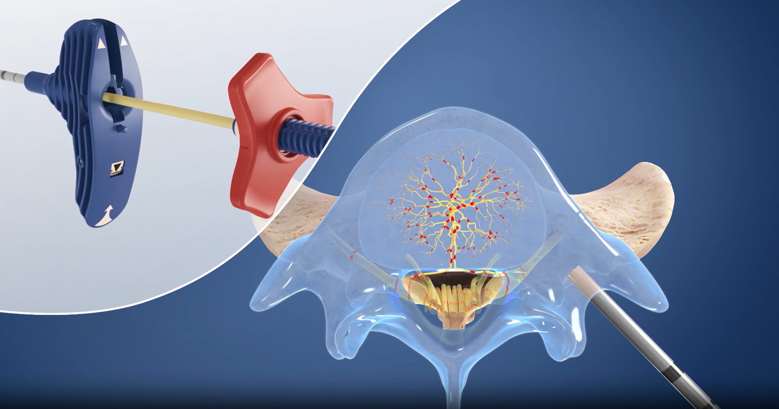 An Illustration Of A Spine With A Needle In It